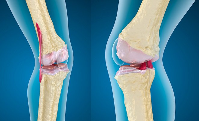 Baja ingesta de calcio aumenta riesgo de osteoporosis y fracturas
